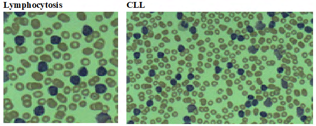 Figure 9: Picture showing lymphocytosis and chronic lymphocytic leukaemia.