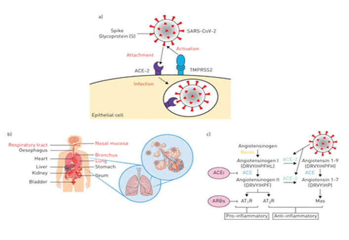 Figure 1: Schematic representation of a) severe acute respiratory syndrome coronavirus 2 (SARS-CoV-2) binding to the angiotensin-converting enzyme 2 (ACE-2) receptor following activation of the spike protein (s) by transmembrane serine protease 2 (TMPRSS2), which leads to endocytosis and infection. b) Human organs that have shown ACE2 expression, with the respiratory system highlighted in red. c) The renin–angiotensin system (RAS) and the proposed SARS-CoV-2 action. The generation of angiotensin II from angiotensin I by angiotensin-converting enzyme (ACE) induces vasoconstriction of blood vessels and pro-inflammatory effects through the binding of angiotensin II receptor type 1 (AT1R) Courtesy: European Respiratory Journal.