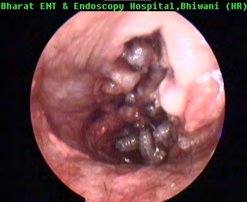 Figure 1: Photograph showing endoscopic intra aural view of maggots.