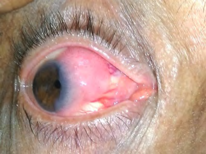 Figure 1: A 60 years-old male patient with giant ocular surface squamous neoplasia (OSSN) in the right eye.