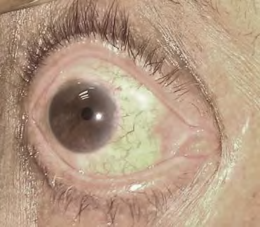 Figure 2: Showed complete tumour regression with three cycles of topical and perilesional INF α2b injections.
