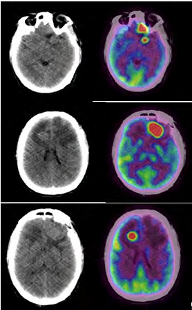 Figure 1: Shows hypodense focal hypermetabolicareas in right rontal lobe (SUVmax 29.0), left frontal lobe (SUVmax 27.6) and left temporal lobe (SUVmax 32.3).