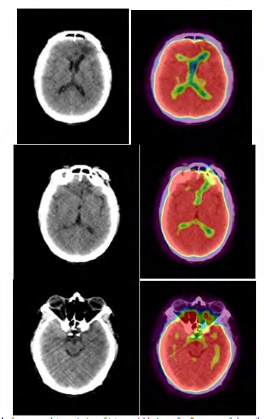 Figure 4: shows complete remission of intracranial lesions after 8 courses of chemotherapy.