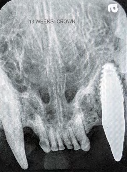 Figure 13: Cad/Cam milled wax crown on the mounted models to verify relationship with the opposing arch.