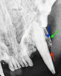 Figure 2: Deep probing (red) with osseous expansion of the socket wall (green) and condensing bone (blue) demonstrating a mottled trabeculae pattern in the radiograph (yellow).