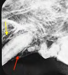 Figure 3: Following extraction of the affected canine a full thickness envelop flap is elevated to expose the buccal aspect of the extraction socket.