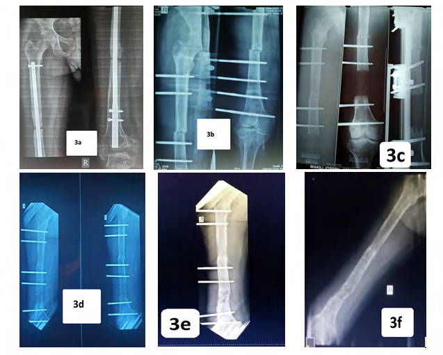Figure 3: Radiographs (a) Preoperative period (infected left femoral IM Nail), (b) Postoperative radiographs with LRS and corticotomy done, (c) Post-distraction (d) at early consolidation (e) Post consolidation of the regenerate, (f) Post removal of LRS.