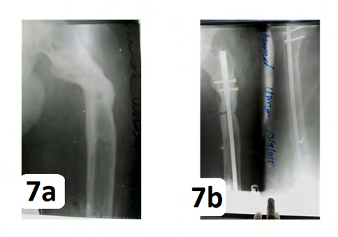 Figure 7: (a) varus malalignment in a proximal femur after lengthening using LRS. (b) after the corrective osteotomy.