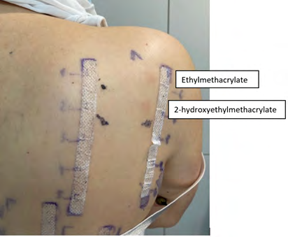 Figure 3: Positive patch tests to 2-hydroxyethylmethacrylate and Ethylmethacrylate.