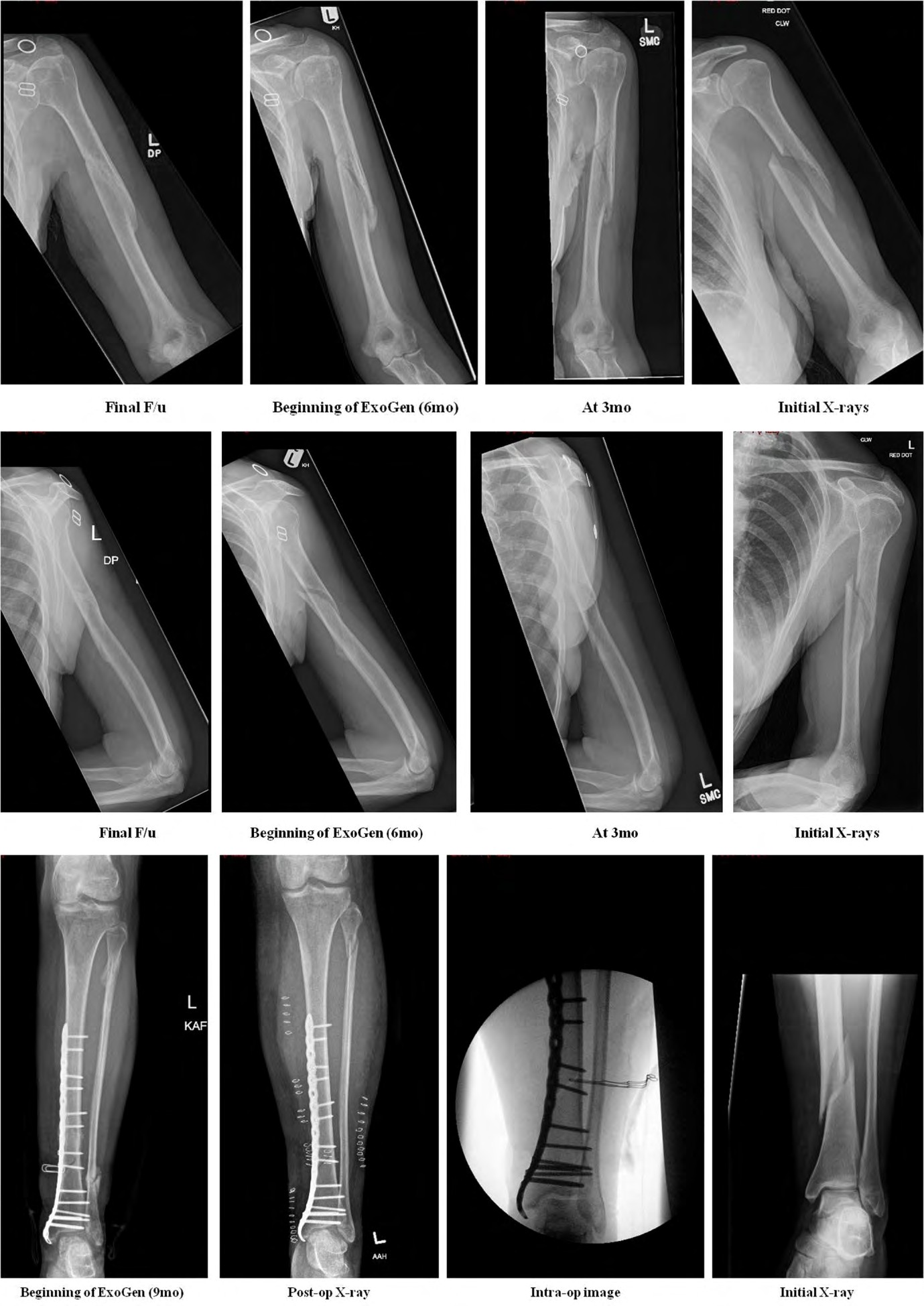 Figure 4: An index case of ExoGen failure for a hypertrophic non-union of Tibial diaphyseal fracture that was initially treated by a locking plate fixation in a 46/F who was a smoker and had Vitamin D insufficiency is illustrated in Figure 5. This individual eventually needed a revision surgery and underwent implant removal, debridement of fracture site and two lag screws fixation. Fracture healing was achieved at one year post-revision surgery. Key radiographs of this patient are illustrated in Figure 6 respectively.