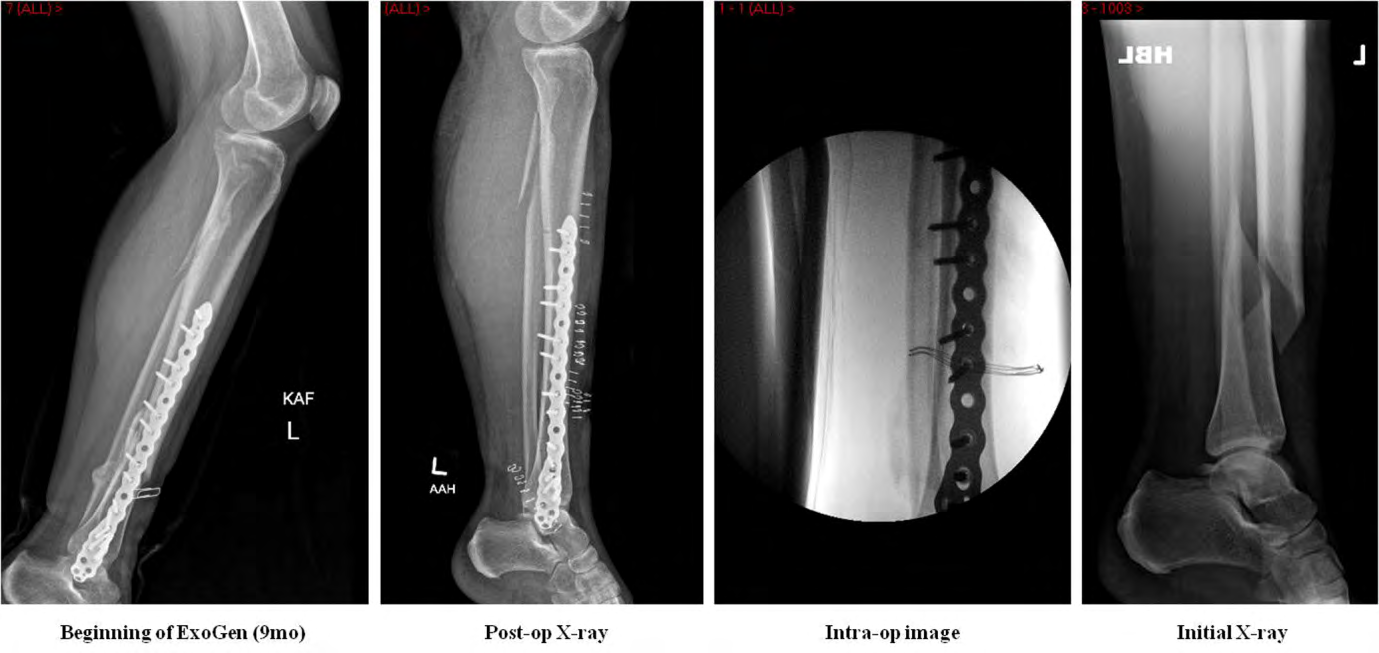 Figure 5: AP & Lateral radiographs illustrating hypertrophic non-union in a Tibial diaphyseal fracture treated by a locking plate and extended use ExoGen (≥325 sessions).