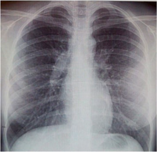 Figure 3: Sarcoidosis in 16-year-old girl. Shortness of breath (CRF I). Figure 3a: Chest X-ray: multiple lesions in the lung parenchyma.