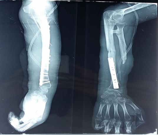 Figure 3: The Watson Jones technique.
