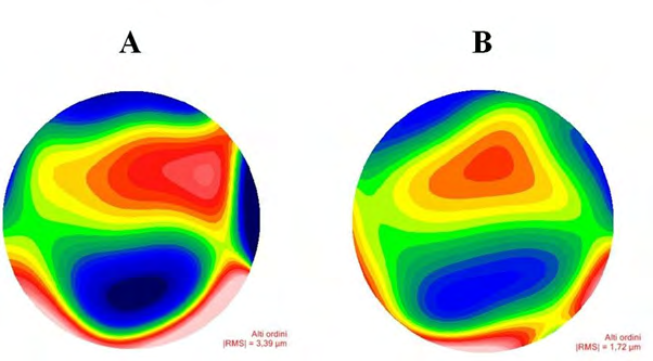 Figure 2: Corneal High Order Aberrations for 5.0mm pupil (Sirius scheimplflug camera, CSO, Italy) measured before (A) and 8 years after (B) femtosecond laser arcuate keratotomy.