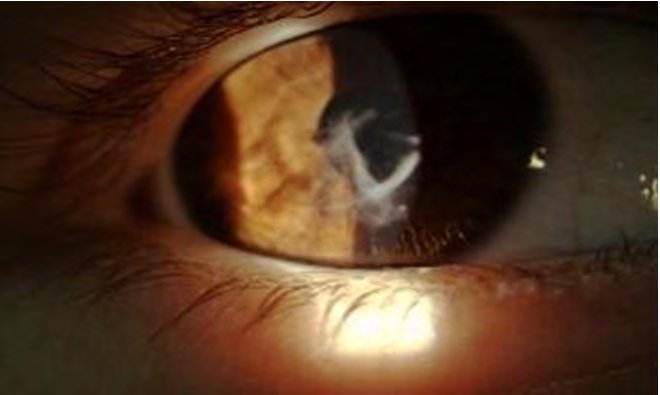 Figure 3: Cornea scars at the slit lamp examination.