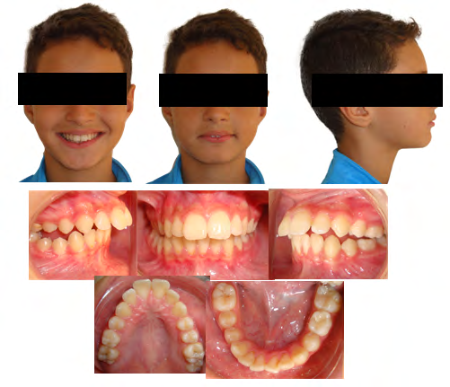 Figure 1: Pre-treatment extraoral and intraoral photographs.