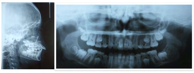 Figure 2: Pretreatment OPG and cephalogram.