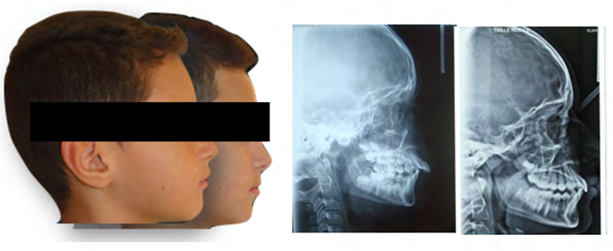 Figure 3: Monobloc activator.