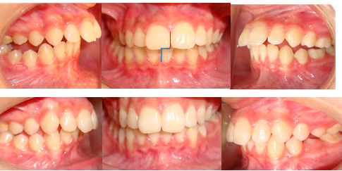 Figure 7: post treatment intra oral and extraoral photographs.