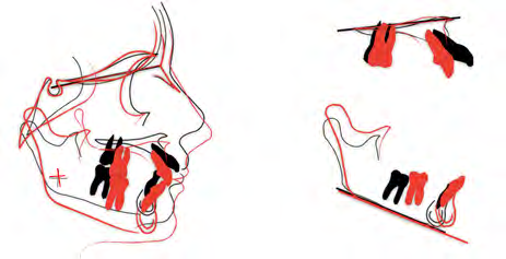 Figure 8: Post-treatment OPG and Cephalogram.