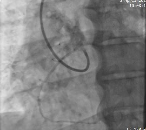 Figure 3: Right Femoral Angiogram with JL 3.0 Showing Anomalous RCA Origin from Opposite Sinus and Subsequent Angioplasty with Micro Catheter Support.