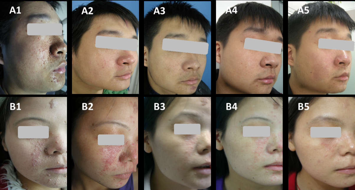 Figure 3: Facial views of two patients after therapy with multiple lasers. Before treatment, (A1, B1), 3 month later after first treatment (A2, B2), 6 months (A3, B3), one year later (A4, B4), and two years later (A5, B5) after the treatment.