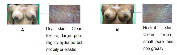 Figure 3: A. Preoperative: Female patient with an area of hyperpigmented and dry skin in the upper internal quadrant due to depression and absence of subcutaneous cellular tissue secondary to excision of the left giant fibroadenoma. B. Postoperative: Filler effect regulated post-surgical depression, smooth, moist skin with uniform pigmentation.