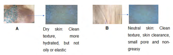 Figure 4: A. Preoperative: Female patient with hyper pigmented, dry, rough, rigid, fibrosed, indurated and retractile skin secondary to gluteal injection of allogenic substances. B. Postoperative: Improvement of hyperpigmentation, smother, moist and flexible skin.