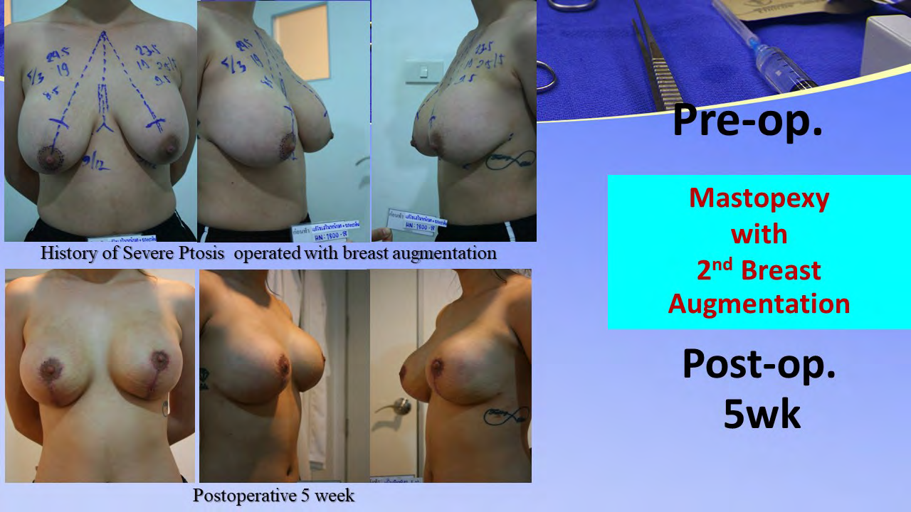 Figure 7: Case II: Patient with previous second mastopexy with breast augmentation. Her problems are multioperated, widening of periareolar and vertical scar, capsular contracture grade II and unequal breast. This case was managed by scar excision, areolar reduction, capsulotomy and partial capsulectomy, third mastopexy and breast augmentatiom. Pictures show preoperative markings, unequal breast, widening of scar both sides and two months postoperatively.