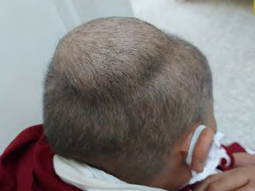 Figure 1: Clinical examination showing the cranial swelling.