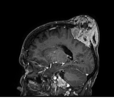 Figure 2: Sagittal slice MRI image objective cranial vault lesion with subcutaneous mass.