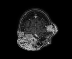 Figure 3: T1 axial slice MRI image showing multiple bone lesions with meningeal extension.