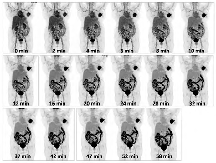 Figure 3: Dynamic images acquired as multiple passes of the whole body for 60 minutes soon after intravenous administration of 18F-FDG. The first 5 passes are of 2 minutes duration per pass and the subsequent 6 to 15 passes are of 5 minutes duration per pass, with a total duration of 60 minutes acquisition. _(Image Courtesy: Department of Nuclear Medicine, Apollo Proton Cancer Centre, Chennai, India_).