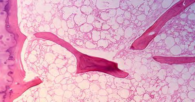 Figure 2: Aseptic necrosis of bone delineating intensely stained trabeculae with empty lacunae, focal calcification and foci of necrotic adipocytes [12].