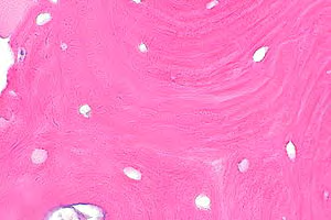 Figure 4: Aseptic necrosis of bone exhibiting a dense, uniform appearance with empty lacunae and a margin of fibrotic tissue [14].
