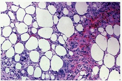 Figure 5: Aseptic necrosis of bone with necrotic adipose tissue, calcified, intensely stained bone trabeculae and circumscribing fibrous tissue [15].