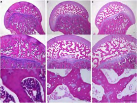 Figure 6: Aseptic necrosis of femur demonstrating diverse stages with empty lacunae, cracking and discontinuity of bone contour, intensely stained dead bone, calcification of adipose tissue and necrotic bone and peripheral fibrous tissue [16].