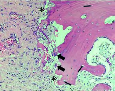 Figure 7: Aseptic necrosis exemplifying darkly stained bone trabeculae with deposits of calcium, necrotic adipocytes and a circumscription by fibrous tissue [17].