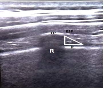 Figure 1: Erector spinae plane (ESP).