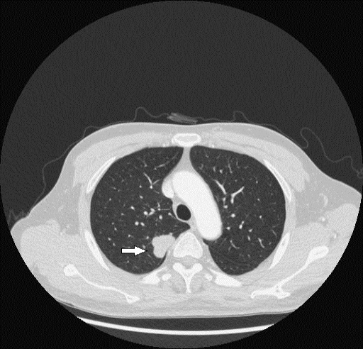 Figure 1: Male, 58 years old. He had no symptom and was found lesion in health examination. CT showed mass in upper lobe of the right lung (arrow.). The mass had lobulation.