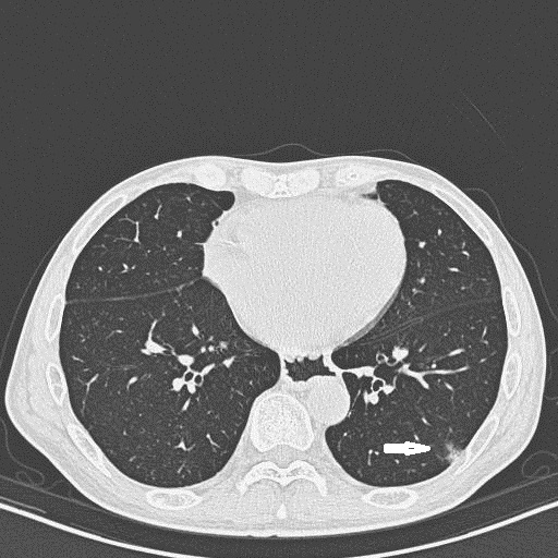 Figure 5: Male, 75 years old. He had no symptom and the lesion ws found in health examination. CT showed patchy consolidation with air-like shadow in low lobe of the left lung.