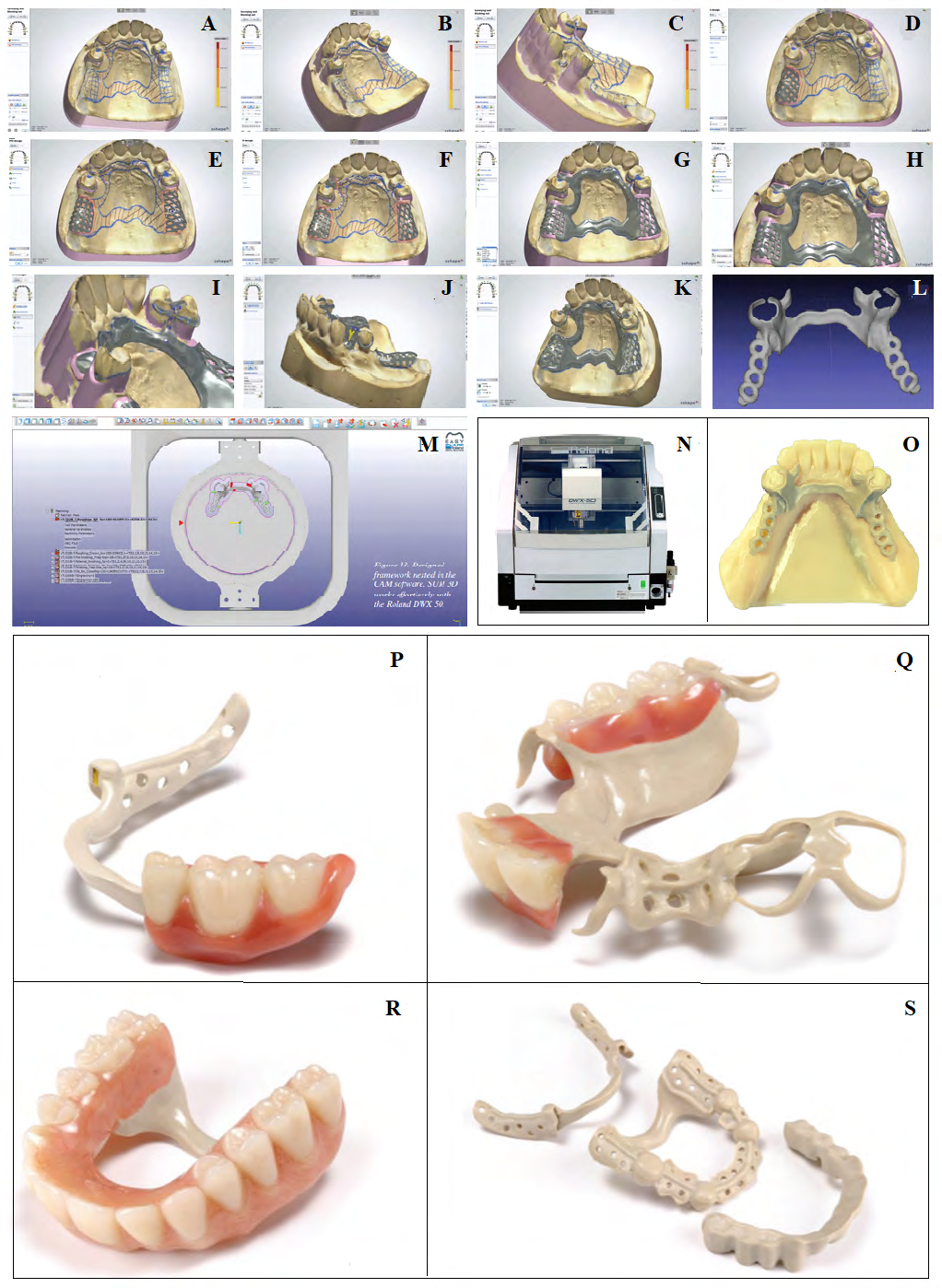 Figure 10: CAD-CAM workflow for making removable prosthetic appliances form PEEK: Photos A-O showing the general workflow of a CAD designed and milled partial denture framework using a Roland DWX 50 Milling unit, SUM 3D CAM software and 3Shape CAD software, and photos P-S show what is possible.