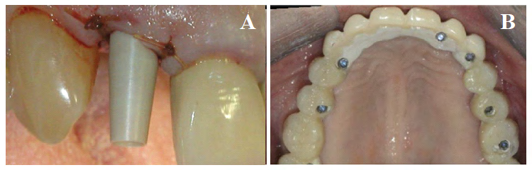 Figure 2: A) A new transitional abutment for immediate aesthetics and function and B) Use of high performance polymers as dental implant abutments and frameworks: a case series report [25].