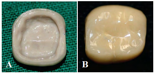 Figure 9: A) Inner surface of the peek crown, B) Outer composite layering.