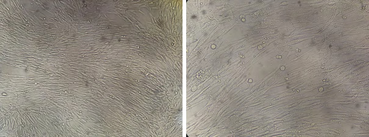 Figure 2: MSCs for treatment of acute oxygen-dependent COVID-19.