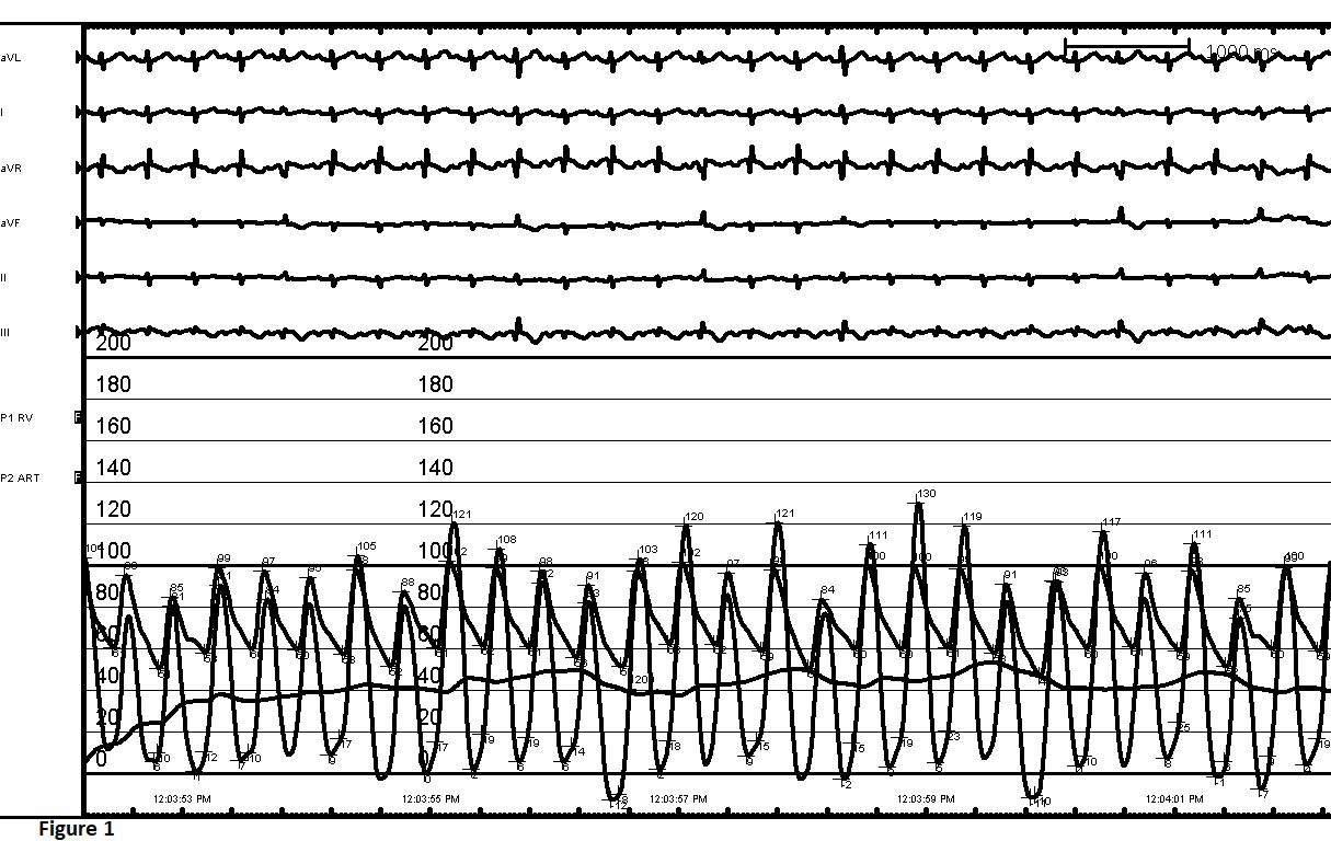 Figure 1: FA and RV Tracing Before BPV.