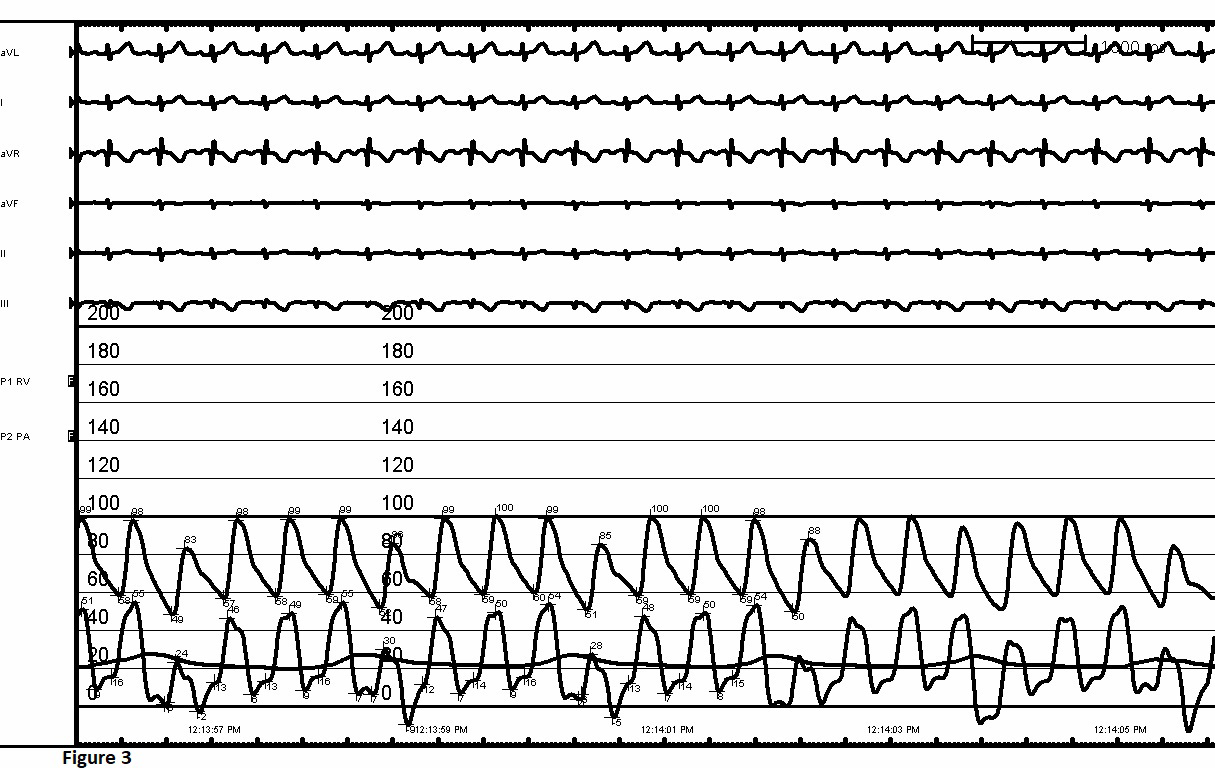Figure 3: FA and RV Tracing Following Metoprolol Injection. Dramatic fall in RV Pressure noted due to Relief of Infundibular Obstruction without any Deterioration of Systemic Pressure.