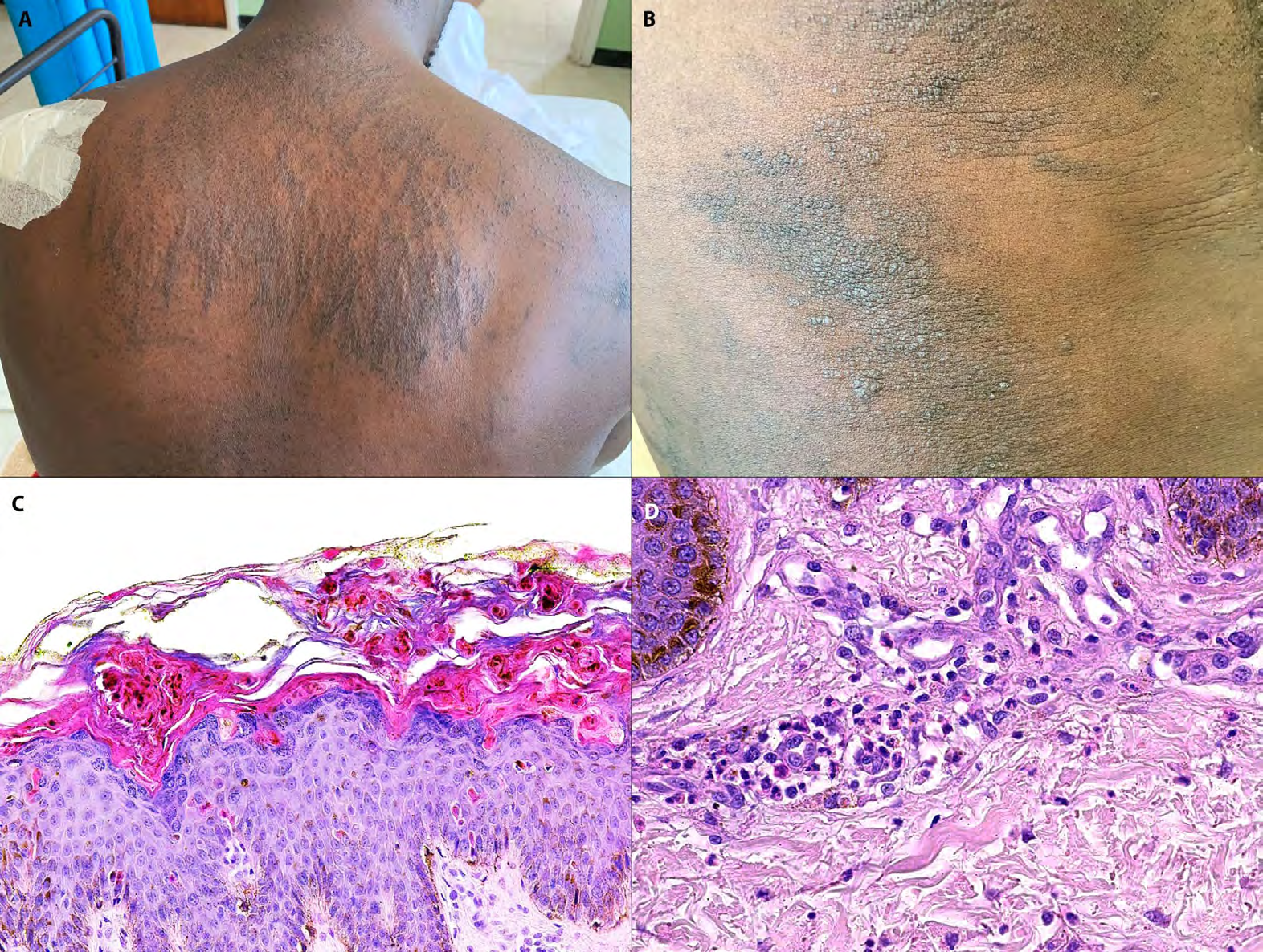 Figure 1: Adult onset Still’s disease. Note Flagellate hyperpigmented plaques on the upper back (A) and brown hyperkeratotic papules on the abdomen (B). Histopathology reveals hyperkeratosis, apoptotic keratinocytes high in the epidermis (C) and an associated neutrophilic infiltrate (D), characteristic of the persistent lesions in adult onset Still’s disease. C-D: Hematoxylin and eosin X200 (C), X400 (D)