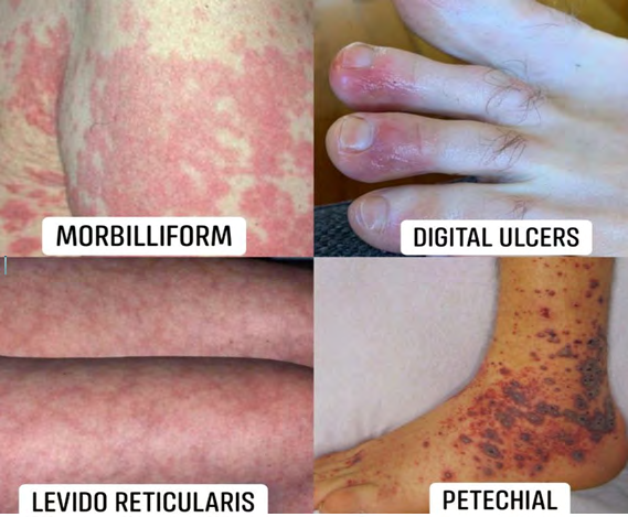 Figure 9: Commonest Skin Rashes to Look for with COVID-1.