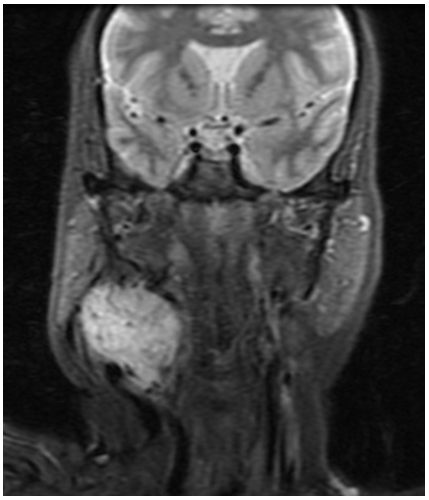 Figure 2: T1 MRI showing isointense lesion.